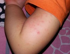 夏季湿疹患者日常注意事项