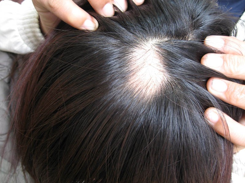 脱发的损害首要包含几个方面