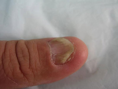 灰指甲带来的损害有哪些