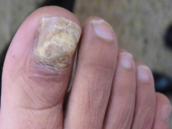 灰指甲初期有什么症状